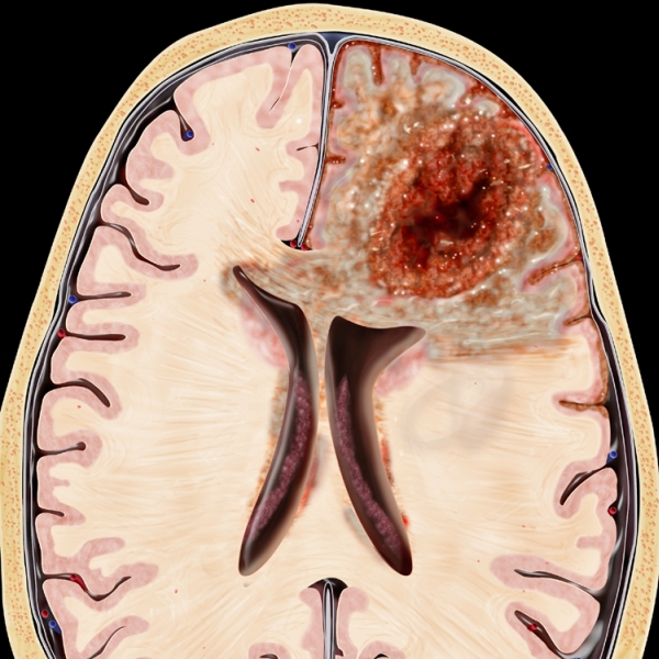 Классификация опухолей головного мозга