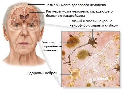 Альцгеймер