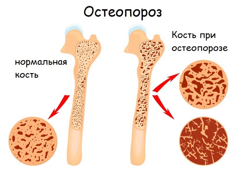Кость при остеопорозе