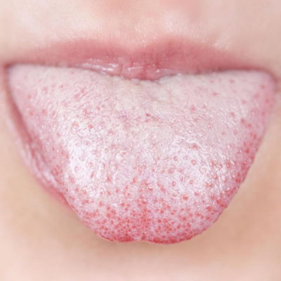 Лейкоплакия рта