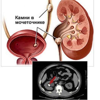 Снимок и иллюстрация мочекаменной болезни