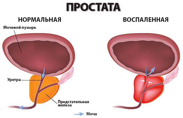 Классификация простатита 